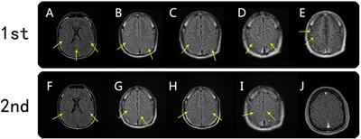 Bilateral Meningo-Cortical Involvement in Anti-myelin Oligodendrocyte Glycoprotein-IgG Associated Disorders: A Case Report